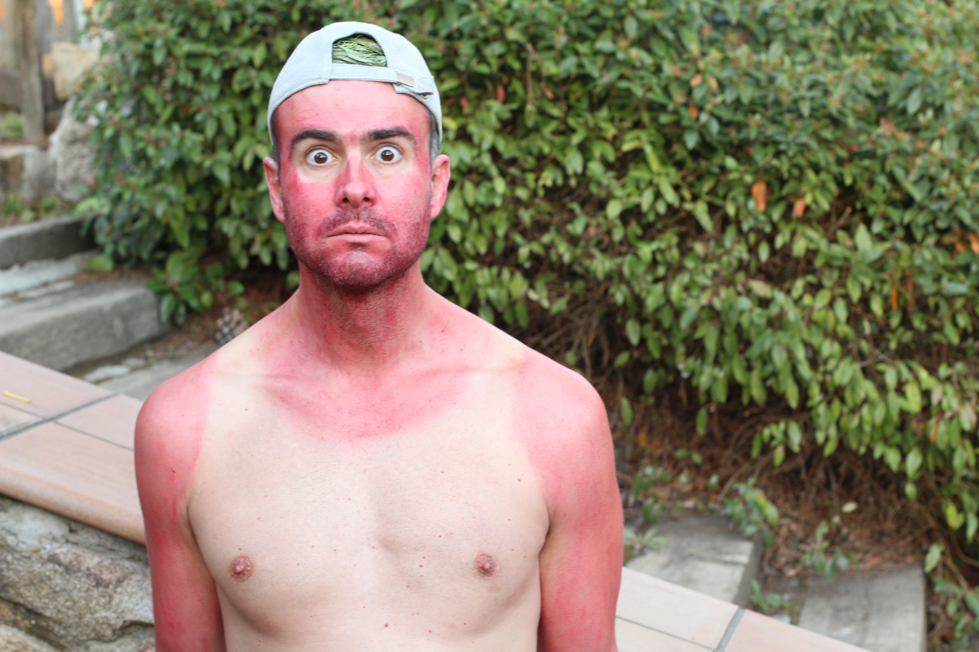 HSE Webinar Targets Outdoor Workers as Skin Cancer Cases Rise Across Ireland