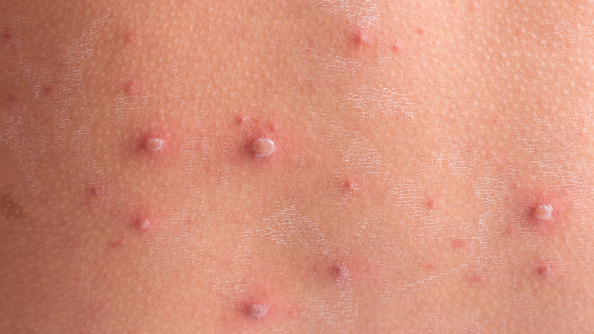 Free Chickenpox Vaccine Available for Cork Babies from Next Week